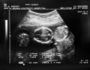 In utero triplets.jpg